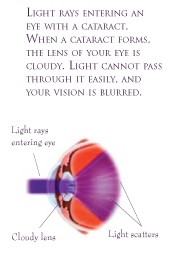 Cataract surgery and symptoms