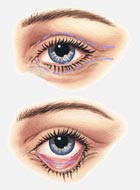 eye lid surgery